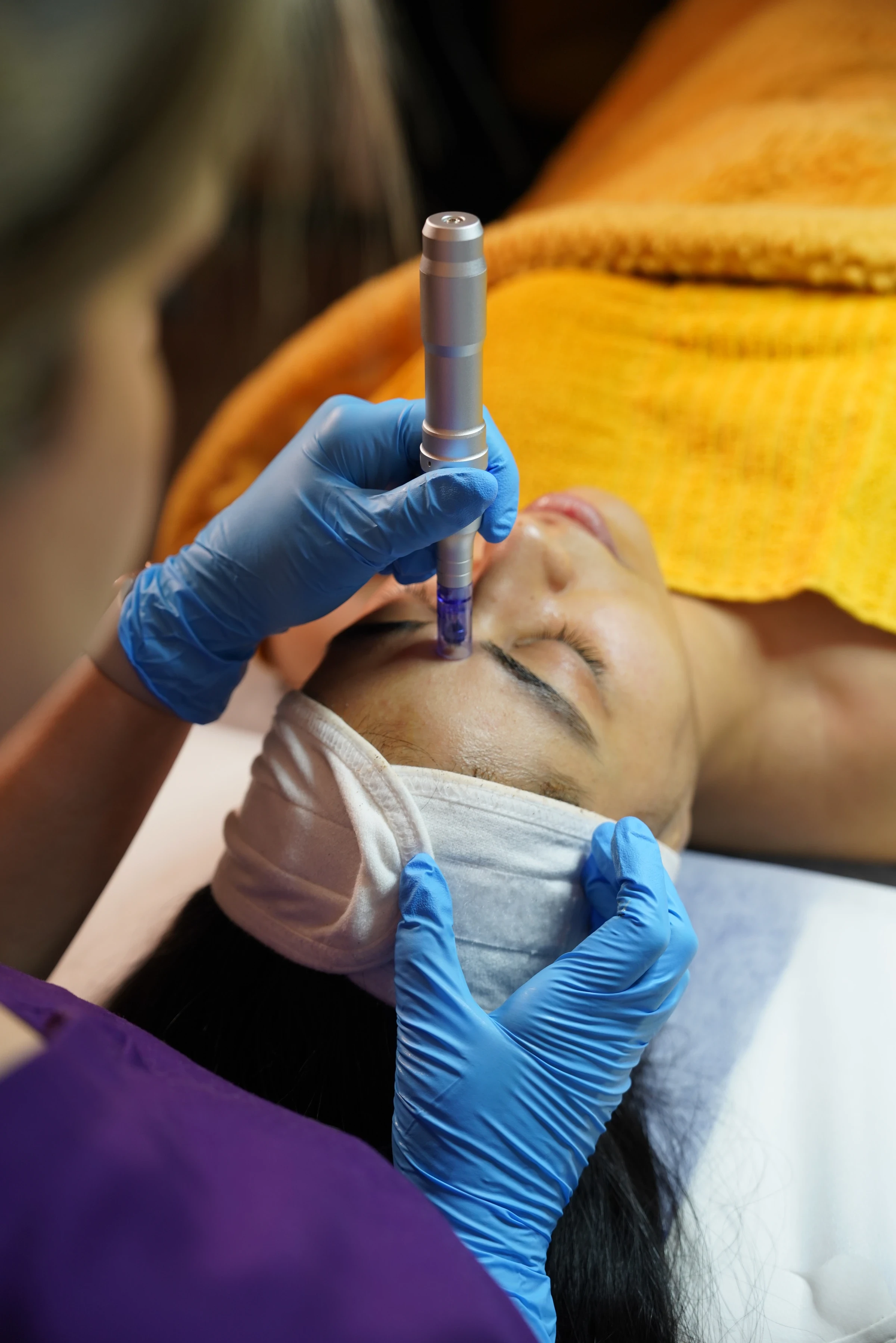 Microneedling pen treatment performed with sterile gloved technique